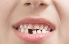 تعبیر خواب افتادن دندان و معنی دیدن دندان در خواب چیست؟