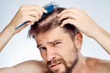 انواع ریزش مو ، علل و روش های درمان آن