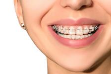 میدلاین یا خط وسط دندان چیست؟